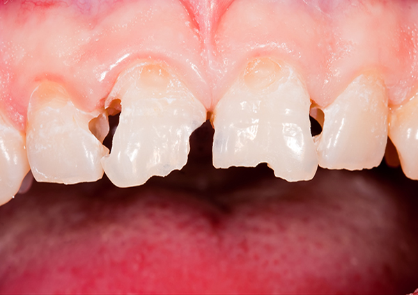 Before-Faux moignons