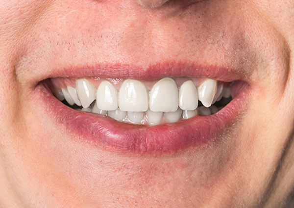 After-Barres Nobel Procera