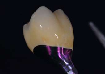 Couronne Transvissée 1