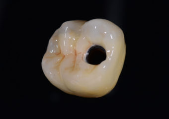 Couronne Transvissée 2